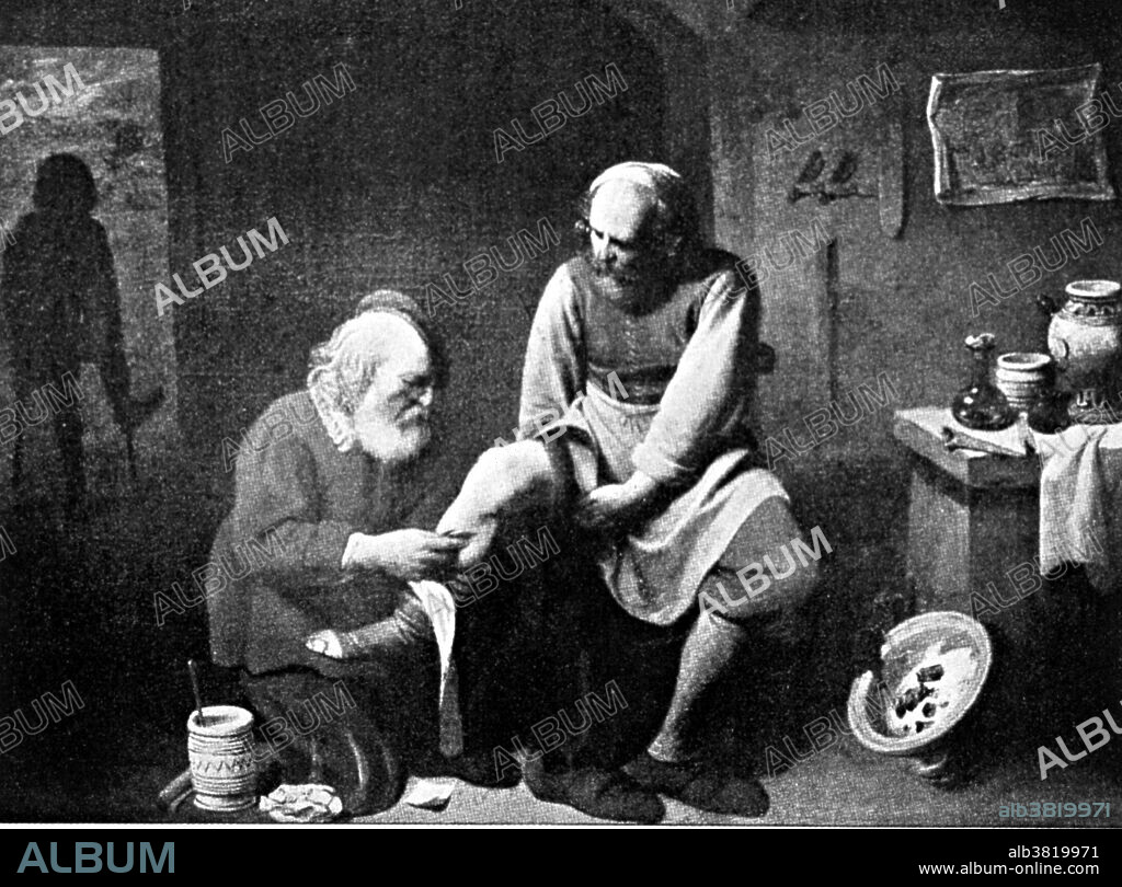 Reproduction of 17th century painting by David Ryckaert of a barber surgeon bloodletting. In Europe in the 13th century a new type of craftsmen emerged in towns; the barber-surgeon. They cut hair, they pulled teeth and they performed simple operations such as amputations and setting broken bones and looking after soldiers during or after a battle. Barber-surgeons performed a technique for reconstructing the nose paving the way for the development of modern plastic surgery. The barber surgeon was one of the most common medical practitioners of medieval Europe. Traditionally barbers have a white and red striped pole outside their shop. In the Middle Ages, when many people were illiterate, barber-surgeons hung out a white and red pole to represent blood and bandages. Bloodletting (or blood-letting) is the withdrawal of often little quantities of blood from a patient to cure or prevent illness and disease. Bloodletting was based on an ancient system of medicine in which blood and other bodily fluid were considered to be "humors" the proper balance of which maintained health, but it often weakened sick patients. It was the most common medical practice performed by doctors from antiquity up to the late 19th century, a time span of almost 2,000 years.