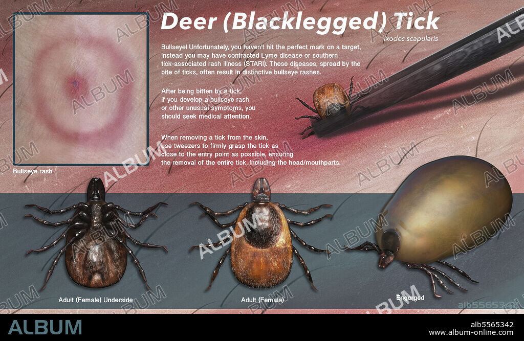 Medical illustration depicting a deer tick's anatomy, along with its bite and removal.