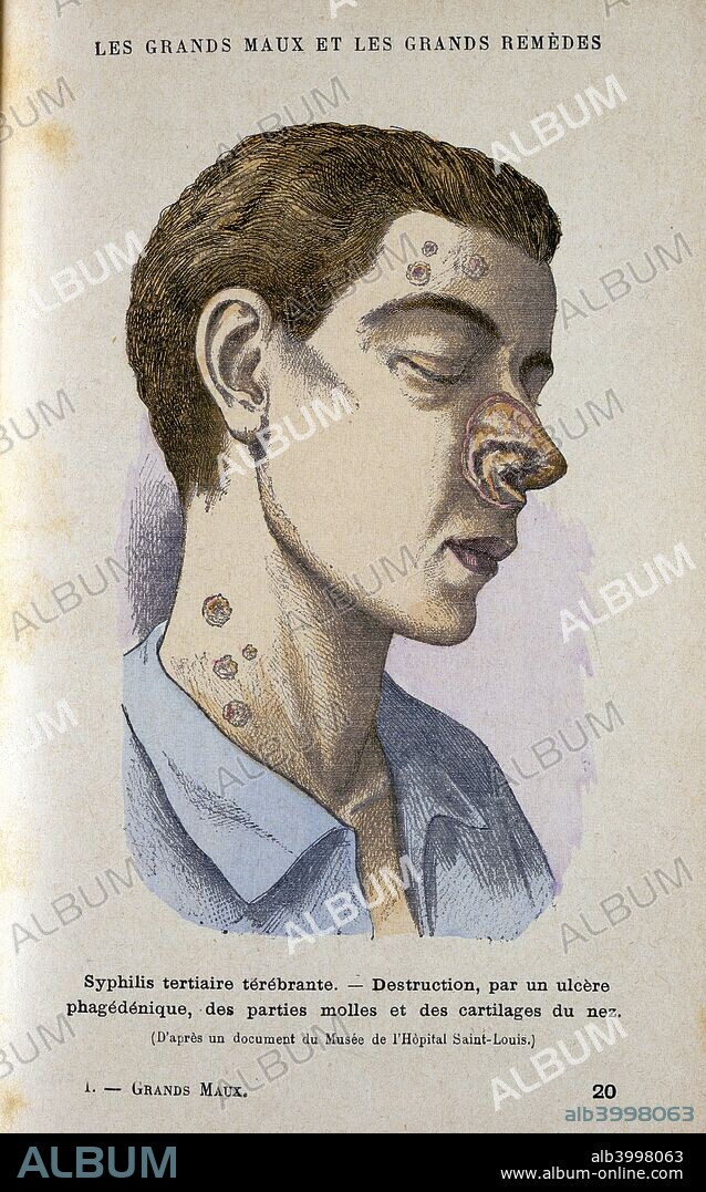 Symptoms of the tertiary phase of syphilis, c19th century. A patient afflicted with sores and ulcers to the neck and face, including one which has destroyed part of the nasal cartilage. The After a document from the Museum of the Hospital of St Louis.