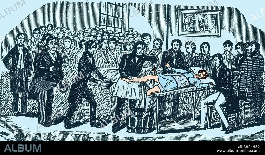 Surgery Without Anesthesia, pre-1840's