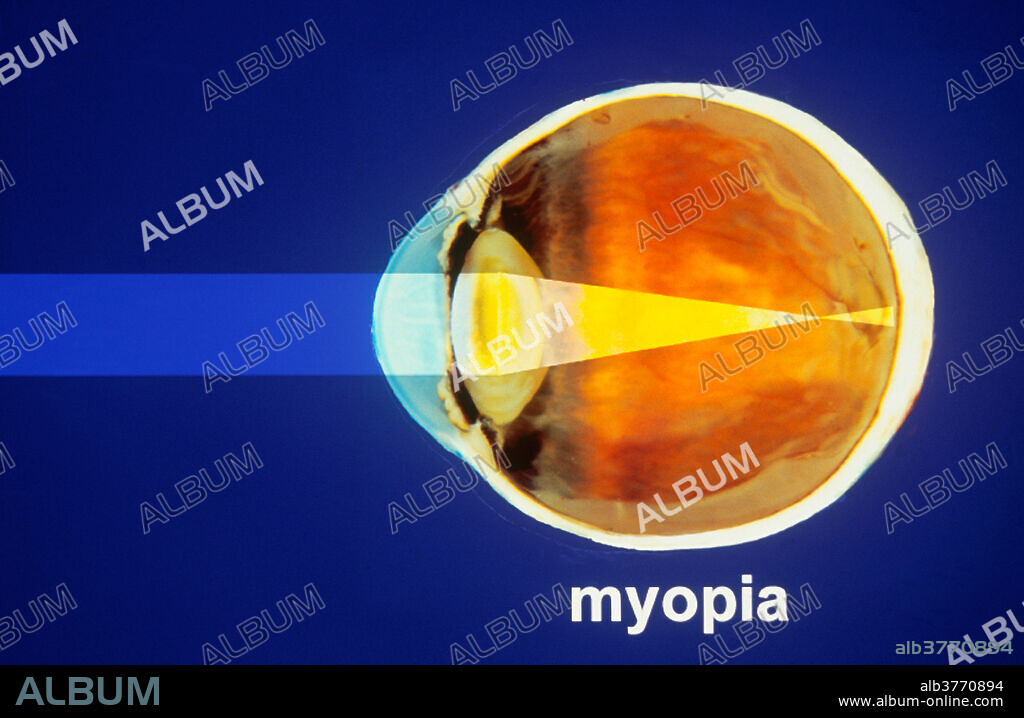 Diagram showing myopia, a defect of the eyes in which the eyeball is too long, or the cornea overly curved. This leads to images being focused in front of the retina, instead of on it. Nearsightedness, or the blurring of objects at a distance, results.