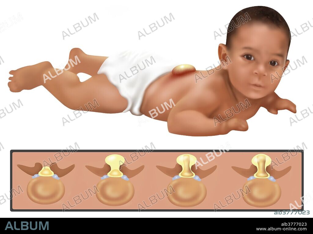 An illustration of a baby with Spina Bifida. Spina bifida is caused by the incomplete closing of the embryonic neutral tube. A development congenital disorder, vertebrae remain incomplete (open) in their formation. If the opening is large enough the spinal chord emerges through the bone. 1 baby in 30 is born with one or more major birth defects. Most are correctable with modern surgery.