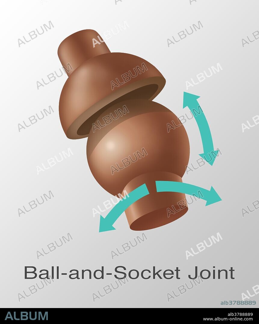 Illustration of a ball and socket joint replacement.