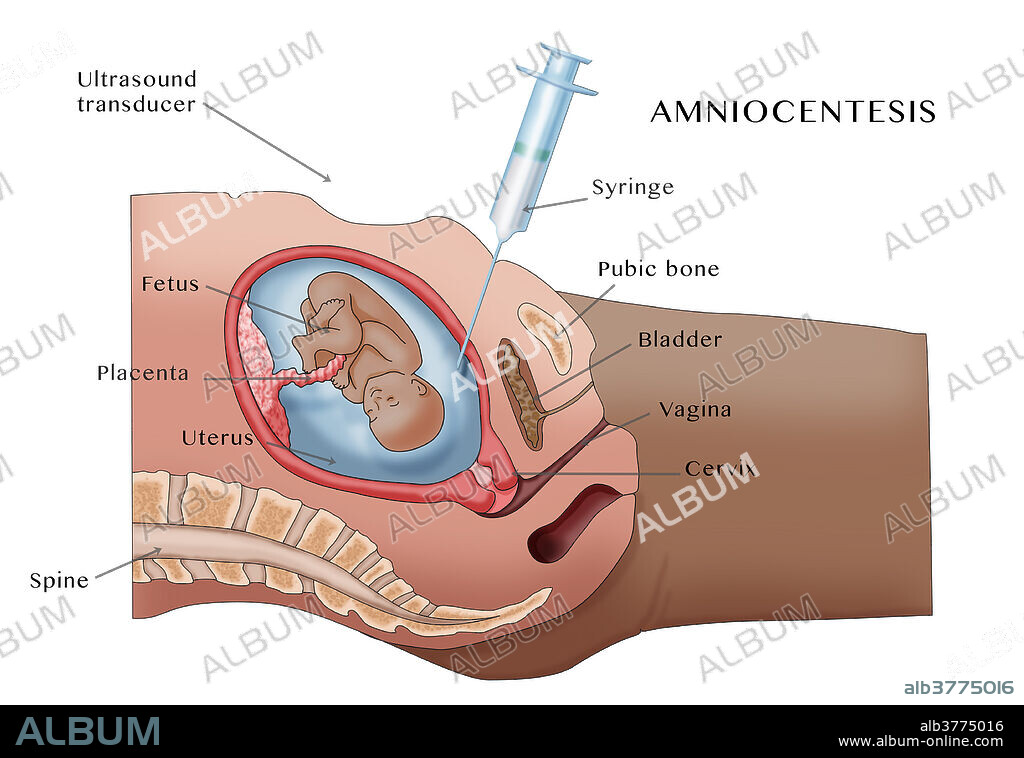 Illustration of amniocentesis (amniotic fluid test or AFT), a medical procedure in which a small amount of amniotic fluid, containing foetal tissues, is sampled and tested for chromosomal abnormalities and foetal infections.