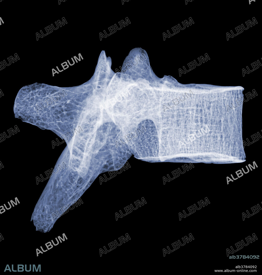 Colour-enhanced X-ray of human lumbar vertebra T5.