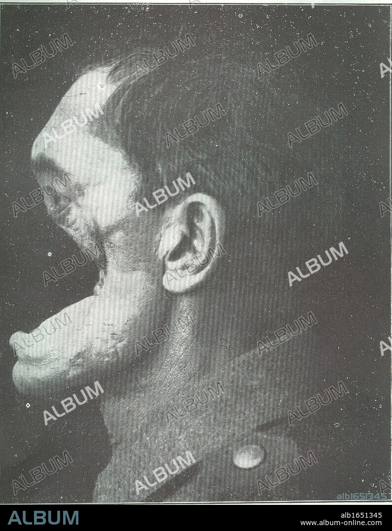 Horror of war: Facial injuries to German soldier in World War I.