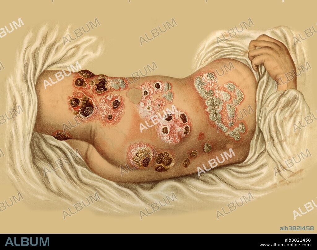 Rupia Psoriasis, Illustration, c. 1880