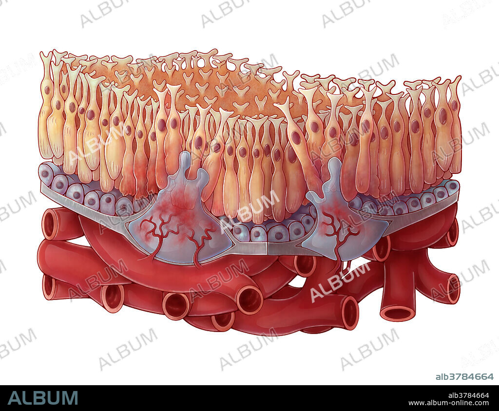 An illustration of wet age-related macular degeneration, a medical condition in which damage to the retina leads to progressive vision loss in one's central field of vision. The macula is a region near the centre of the retina with a high density of photoreceptors responsible for high acuity vision. In wet AMD, blood vessels from the choroid undergo angiogenesis, resulting in abnormal blood vessel growth. Excess blood and fluid proteins leak into the retina and irreversibly damage or displace photoreceptors, resulting in vision loss.