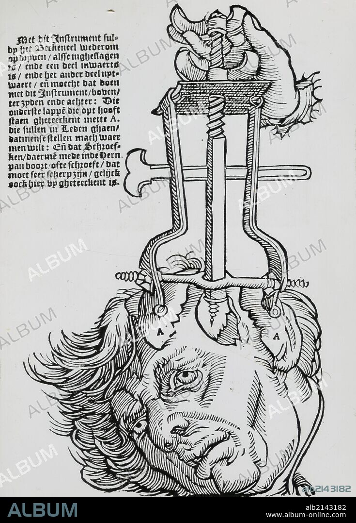 Trephination: elevator for removing fragments of broken skull. Woodcut from a book on field surgery, 1593. (Photo by: Universal History Archive/UIG via Getty Images).