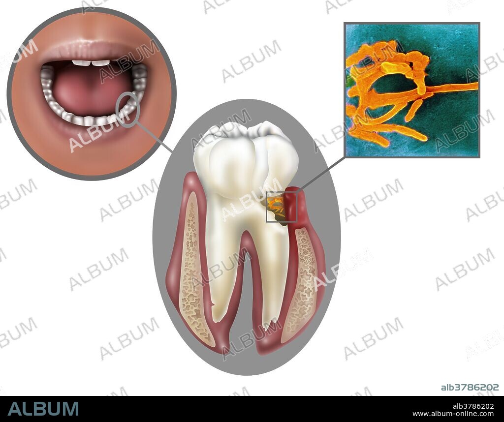 Fusobacterium nucleatum, oral bacteria found in the dental plaque of humans. Associated with the periodontal gum disease.