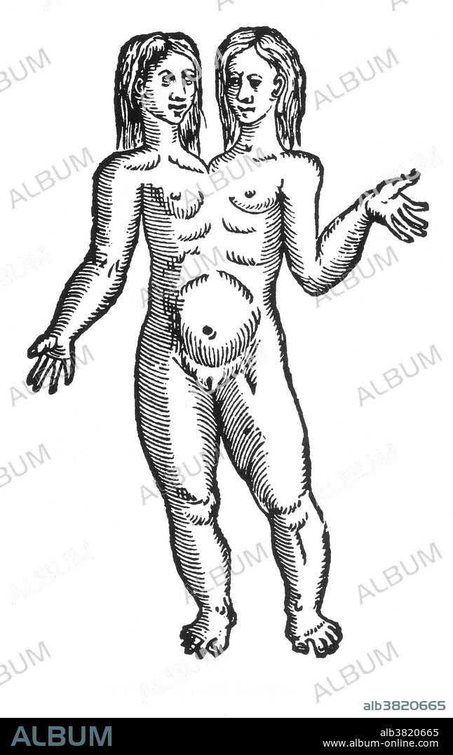 Woodcut of a "girl with two heads" from Des Monstres et prodiges by Ambroise ParÃ©, 1573. Conjoined twins are identical twins born with their bodies joined at some point and having varying degrees of residual duplication, a result of the incomplete division of the ovum from which the twins developed. Parapagus twins are fused side-by-side with a shared pelvis. Twins that are dithoracic parapagus are fused at the abdomen and pelvis, but not the thorax. Twins that are diprosopic parapagus have one trunk and dicephalic. Twins that are dicephalic parapagus are dicephalic, and have two (dibrachius), three (tribrachius), or four (tetrabrachius) arms. Des Monstres is filled with unsubstantiated accounts of sea devils, marine sows, and monstrous animals with human faces. With its extensive discussion of reproduction and illustrations of birth defects, the book invited accusations of pornography.