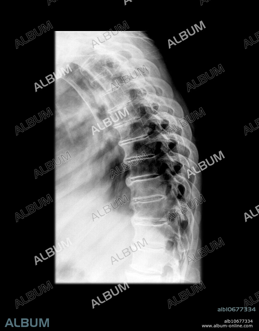 This lateral x-ray of the thoracic spine demonstrates multilevel degenerative changes with disc space narrowing and multilevel vertebral margin osteophytes. Osteoporosis is noted.