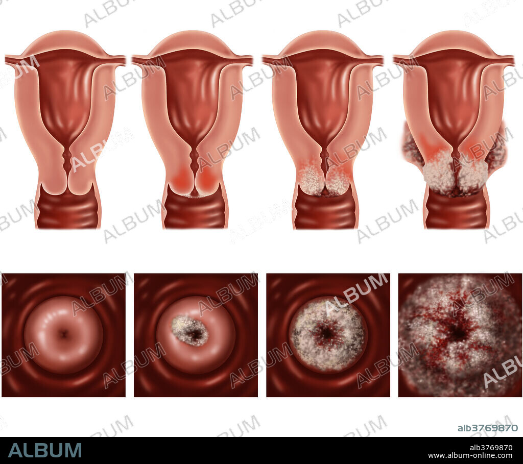 Illustration showing the progression of cervical cancer. Symptoms of cervical cancer include bleeding between periods, pain after sexual intercourse and heavier periods. Cancer of the cervix is rare and if detected early is almost always cured.
