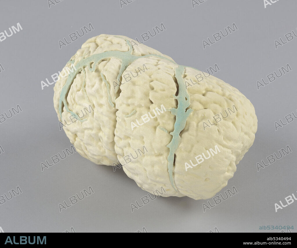 African-American neurosurgeon, author, and politician Benjamin Solomon Carson Sr. (born 1951) served as the 17th United States Secretary of Housing and Urban Development from 2017 to 2021. He was a candidate for President of the United States in the 2016 Republican primaries. This white plaster model shows the conjoined brains of twin sisters Ladan and Laleh Bijani who were joined at the head. Carson, a member of the surgical team that performed an operation to separate the twins, estimated that each sister had a fifty-fifty chance of survival. Unfortunately Ladan and Laleh died immediately after their complicated surgical separation. The veins in the brain are highlighted in a contrasting light blue-green color. Two (2) small holes are drilled into the bottom so the model can be mounted on a stand.