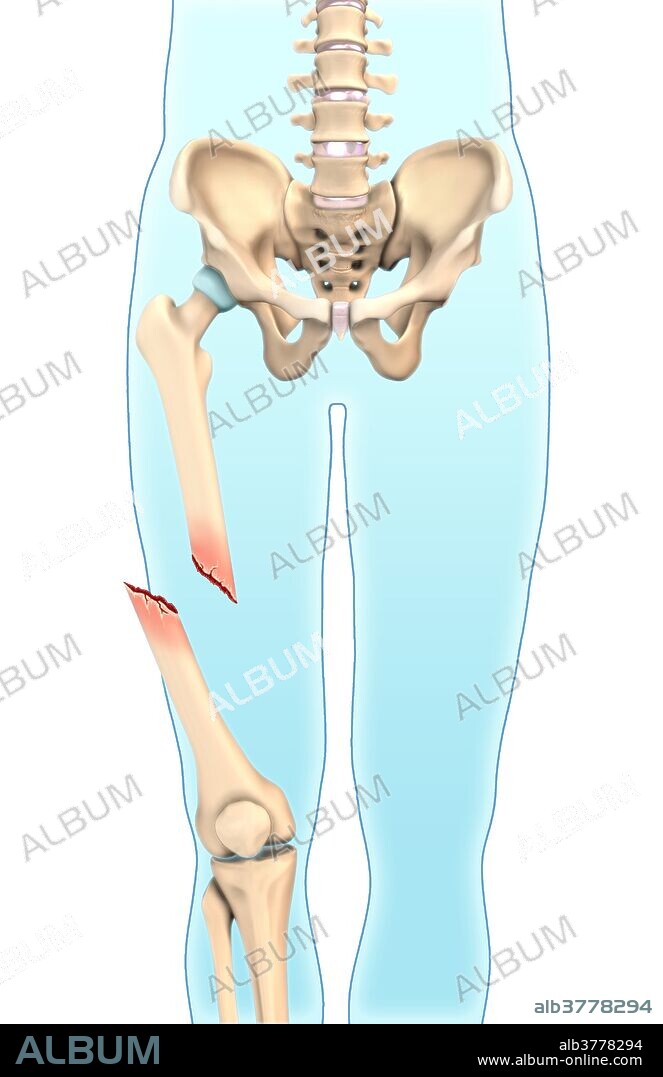 An illustration of a compound fracture in which the bone is exposed outside the skin.