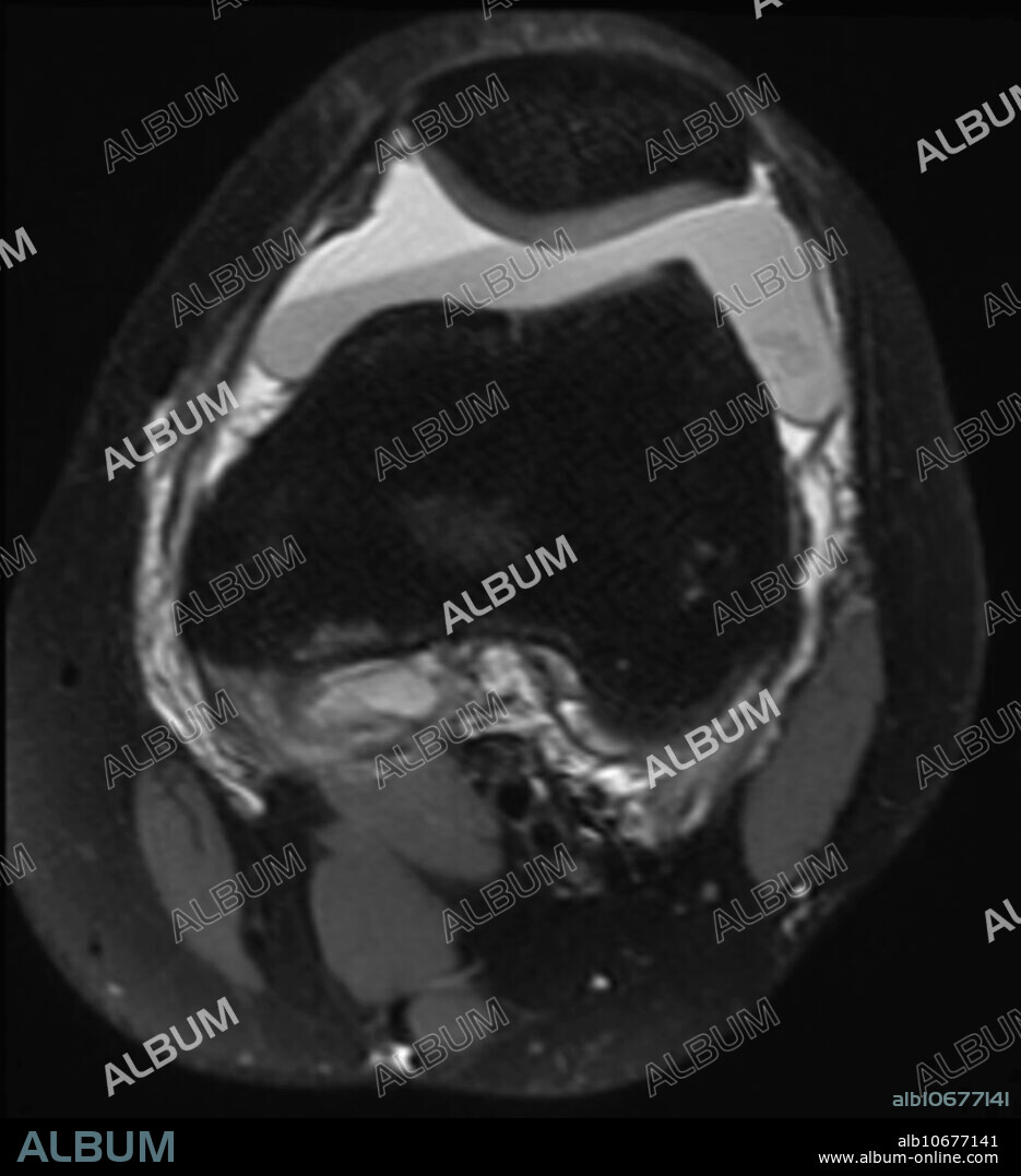 Hemarthrosis, MRI - Album alb10677141