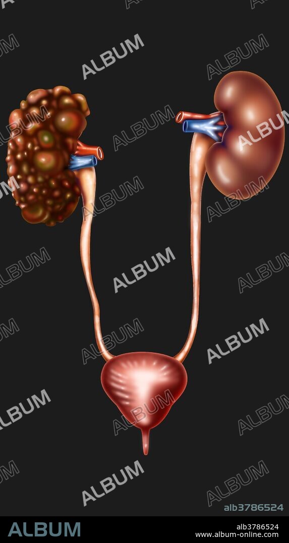 Polycystic kidney disease (PKD or PCKD, also known as polycystic kidney syndrome) is a cystic genetic disorder of the kidneys. There are two types of PKD: autosomal dominant polycystic kidney disease and the less-common autosomal recessive polycystic kidney disease. PKD is characterized by the presence of multiple cysts. The cysts are numerous and are fluid-filled, resulting in massive enlargement of the kidneys. The disease can also damage the liver, pancreas and, in some rare cases, the heart and brain. The two major forms of polycystic kidney disease are distinguished by their patterns of inheritance.