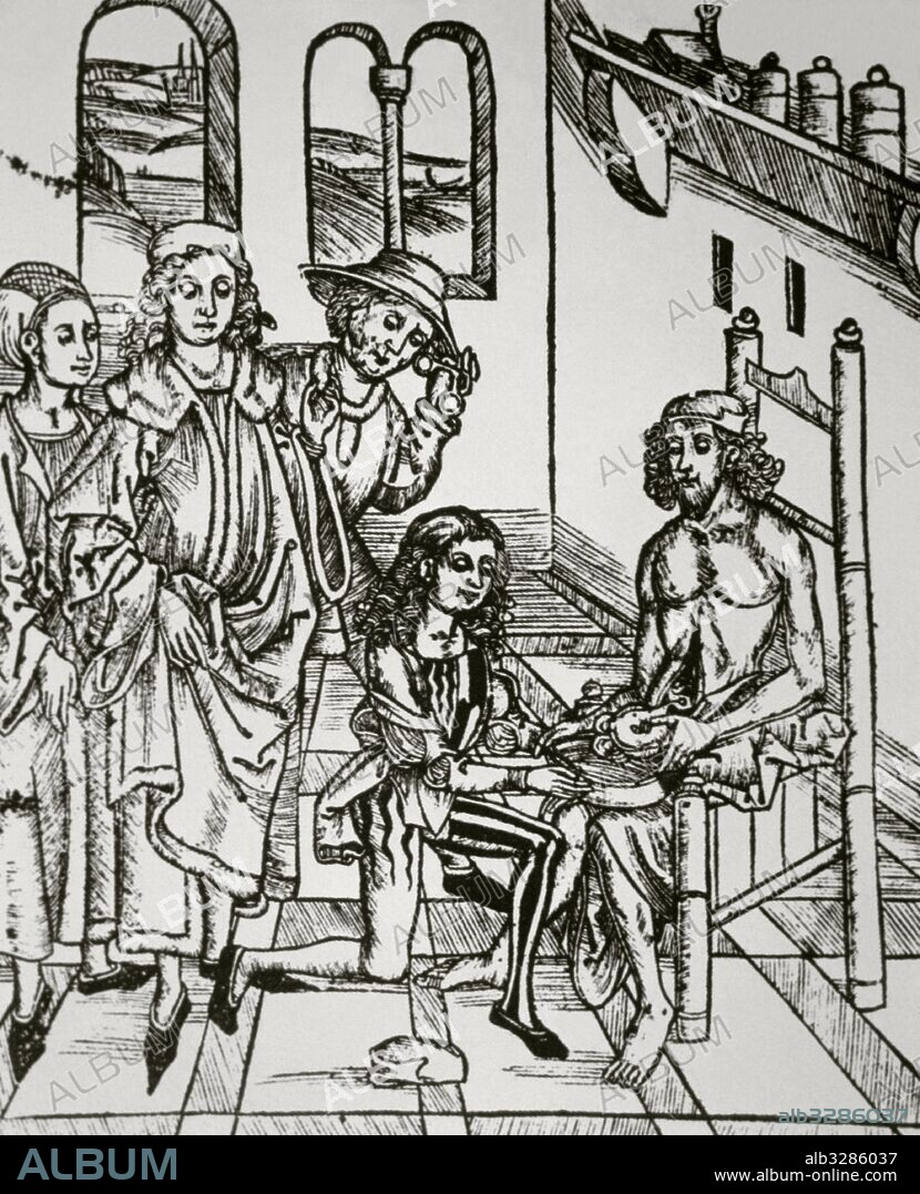 Historia de la Medicina Saturación del intestino. Xilografía de la obra "Dies ist das Buch Der Chirurgia" (siglo XV) .