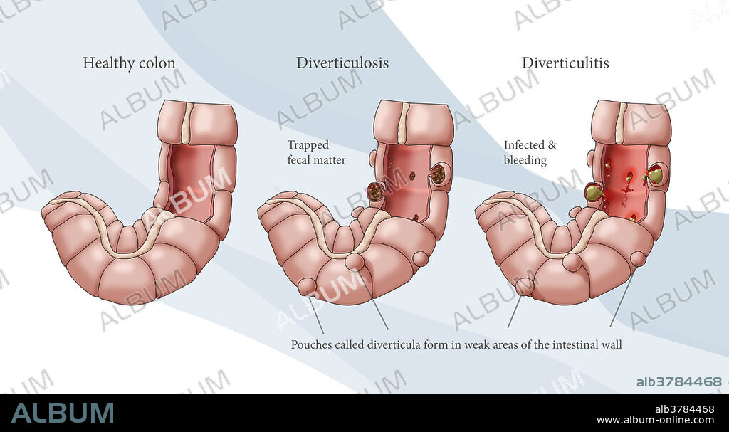 Illustration comparing the appearance of a healthy colon (left); diverticulosis (middle); and diverticulitis (right).