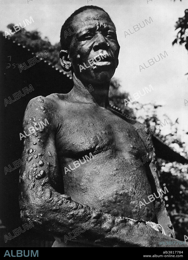 Man with leprosy (Hansen's disease). Mycobacterium leprae is the causative agent of leprosy. It is chronic disease, and progressive if left untreated. It is a disease of the peripheral nerves, and upper respiratory tract. The most prominent symptom is skin lesions. Contrary to belief, leprosy is not highly contagious.