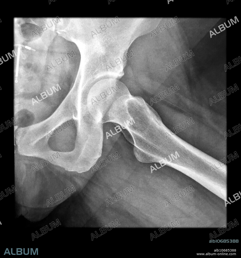 This frog leg lateral x-ray of the hip shows normal anatomy. Please note the incidental IUD (intra-uterine device) in the pelvis.