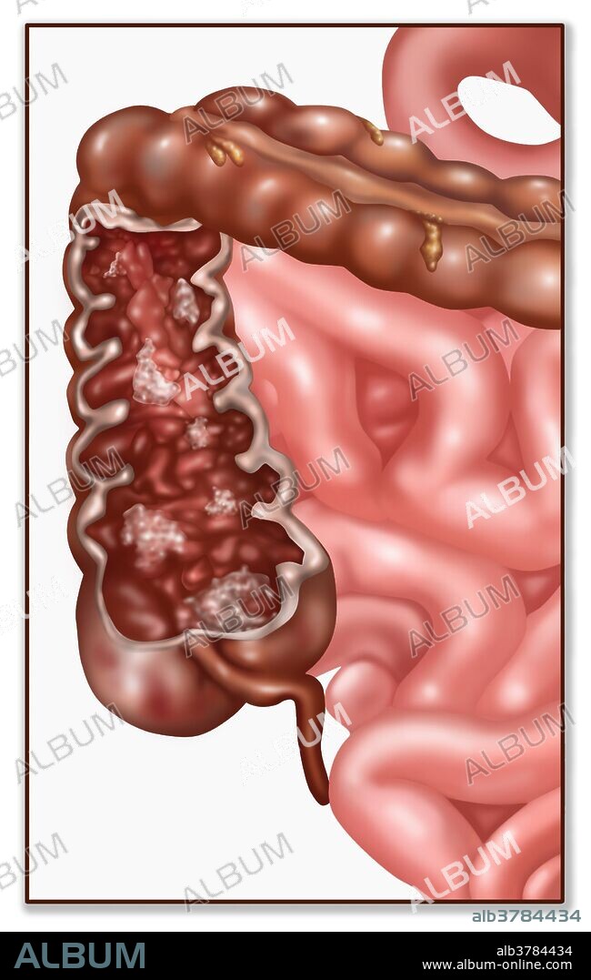 Illustration showing Crohn's Disease. Crohn's disease is categorized as one of the main forms of inflammatory bowel diseases or IBD.