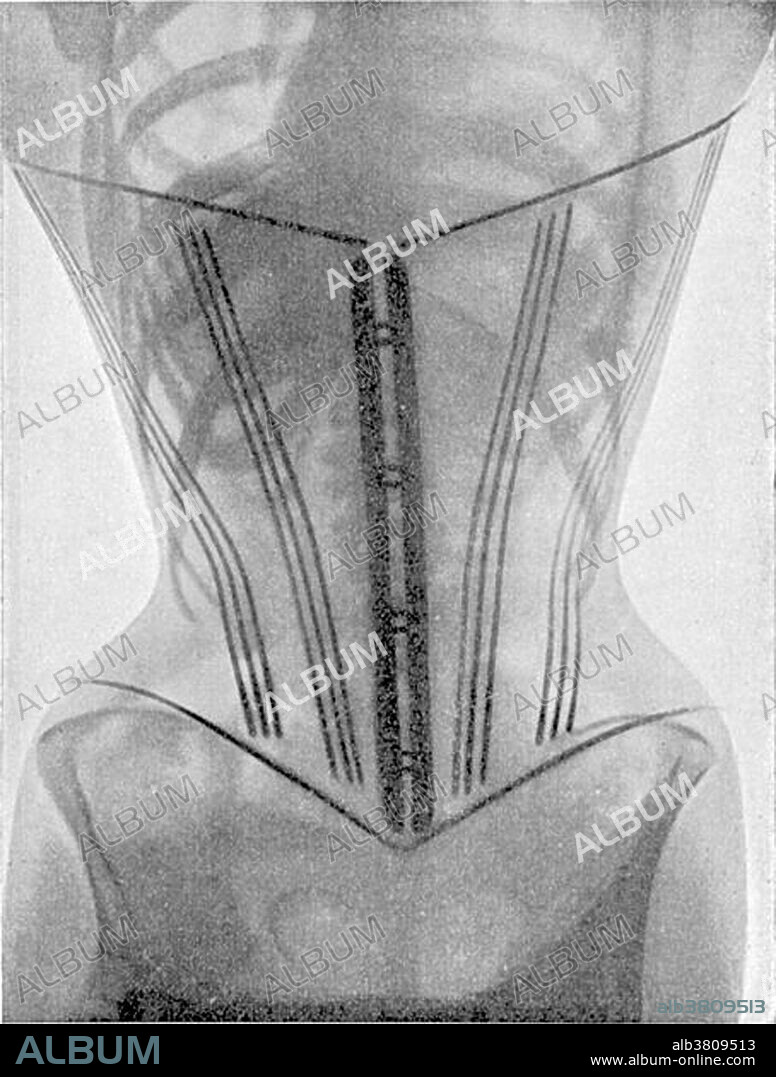X-ray image (frontal view) of a woman wearing a corset from French doctor Ludovic O'Followell's Le Corset (1908). Although Dr O'Followell was eager to show the damaging impact of corsets on women's health, he did not want the corset to abolished but rather hoped to encourage a less severe design. Dr O'Followell in fact continued to write a regular column for the deluxe corsetier's magazine Les Dessous Elegance.