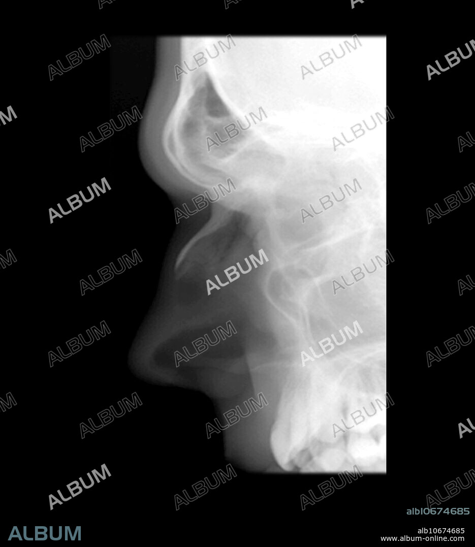 This lateral x-ray of the face shows normal appearance of the nasal bones. These x-rays are often performed when a fracture is suscepted.