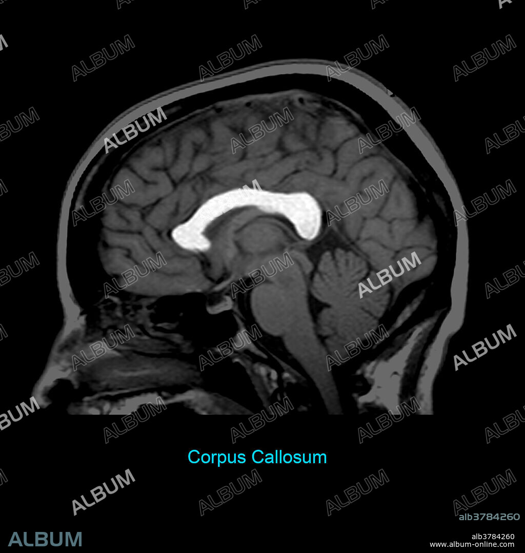 This T1 weighted sagittal (from the side) image of the brain highlights the corpus callosum, which is the largest commissural white matter bundle in the brain.