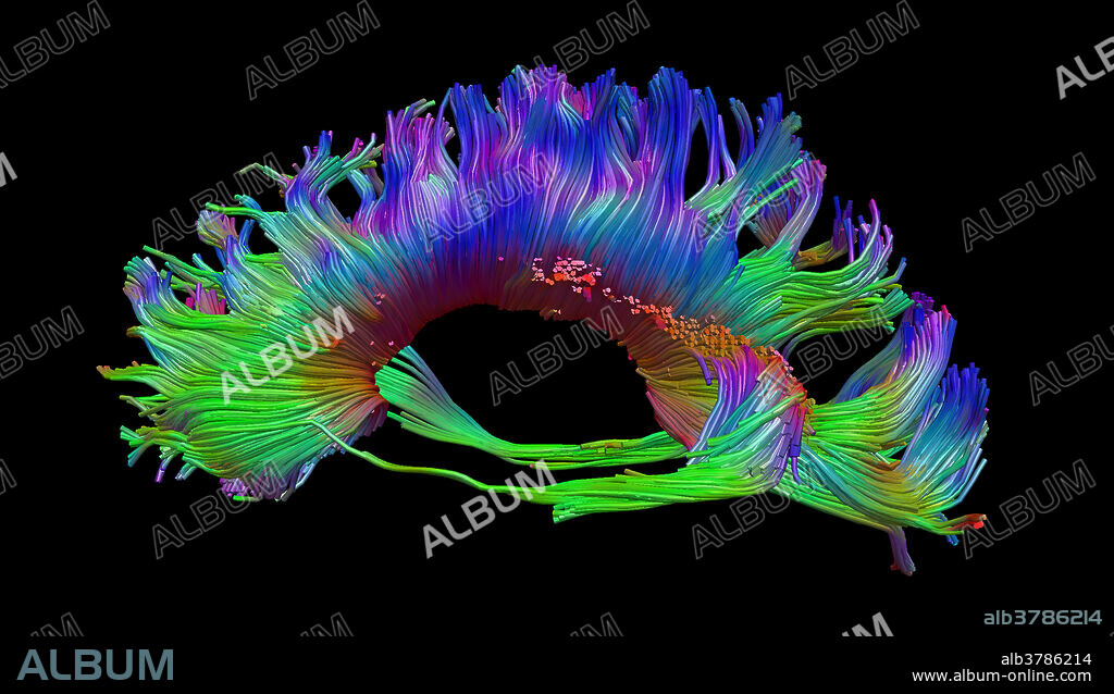This lateral view (from the side; with the subject's nose to the viewer's left) colour image demonstrates the normal appearance of the corpus callosum which is the largest commissural tract in the brain, meaning it connects one side of the brain to the other. By convention the colour is coded so that blue indicates fibre tract direction in the superior (top) to inferior (bottom) direction, red indicates right to left (horizontal) fibre tract orientation and green indicates fibre tract directionality from anterior (front) to posterior (back). The fibre tracts are depicted as tubes in this image.