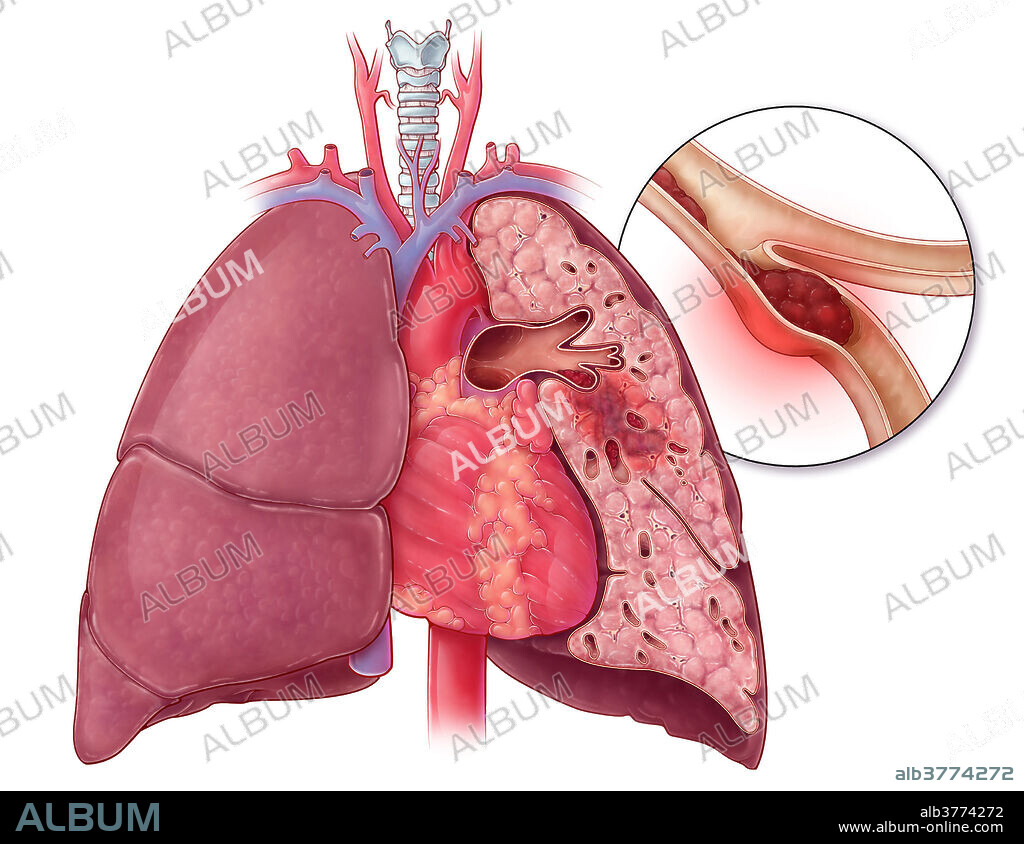 An illustration of a blockage in an artery in the lungs, known as a pulmonary embolism. A pulmonary embolism is most often caused by a deep vein thrombosis, a blood clot (thrombus) in the deep veins of the legs or pelvis, which may break apart, creating an embolus which migrates to the lungs. A small embolus may not present any symptoms, and can dissolve in the lungs over time. A large embolus can result in sudden death if blood cannot reach a large portion of the lung, resulting in cyanosis, difficulty breathing, chest pain, heart palpitations and collapse.