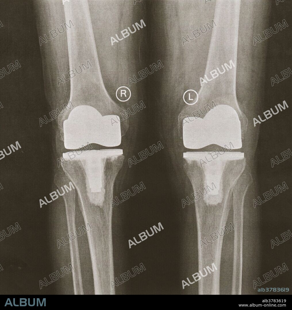 Knees after replacement surgery. X-ray of the knees of a patient after a total knee replacement operation. This is a frontal view of both knees. The implants (white) are brighter than the surrounding bone.