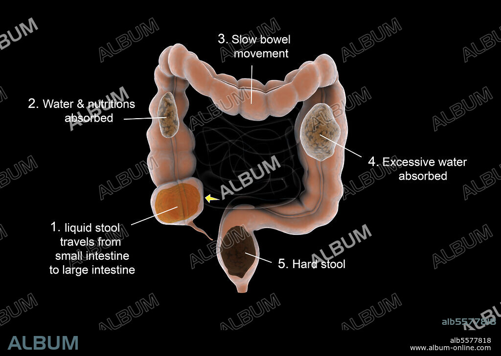 Medical diagram illustrating constipation in the human intestines.