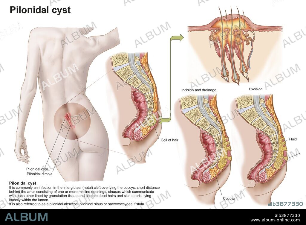 Medical ilustration of a pilonidal cyst near the natal cleft of the buttocks.