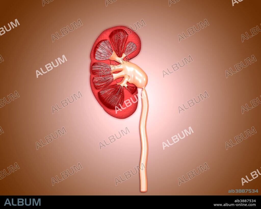 Ureteropelvic junction (UPJ) obstruction in the kidney. UPJ is defined as an obstruction of the flow of urine from the renal pelvis to the proximal ureter.