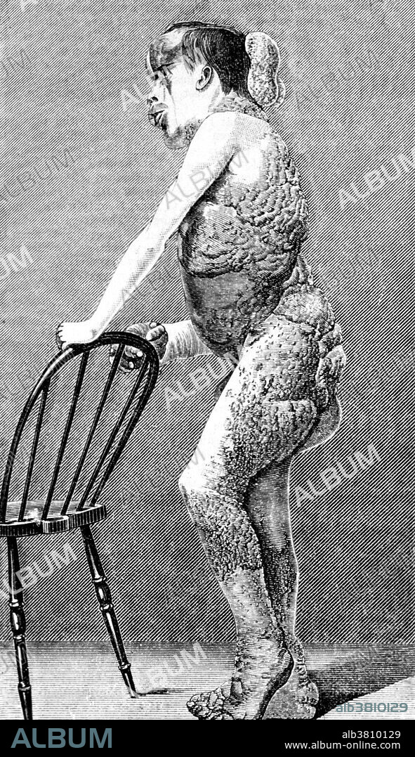 Joseph Carey Merrick (1862-1890) was an English man with severe deformities who was exhibited as a human curiosity named the Elephant Man. He became well known in London society after he went to live at the London Hospital. Although his condition was incurable, Merrick was allowed to stay at the hospital for the remainder of his life. English surgeon Frederick Treves visited him daily and the pair developed quite a close friendship. Merrick was originally thought to be suffering from elephantiasis. He died in 1890, aged 27. The official cause of death was asphyxia, although Treves, who dissected the body, said that Merrick had died of a dislocated neck. The exact cause of Merrick's deformities is unclear. The dominant theory was that Merrick suffered from neurofibromatosis type I. In 1986, a new theory emerged that he had Proteus syndrome. In 2001 it was proposed that Merrick had suffered from a combination of neurofibromatosis type I and Proteus syndrome. DNA tests conducted on his hair and bones have proven inconclusive.
