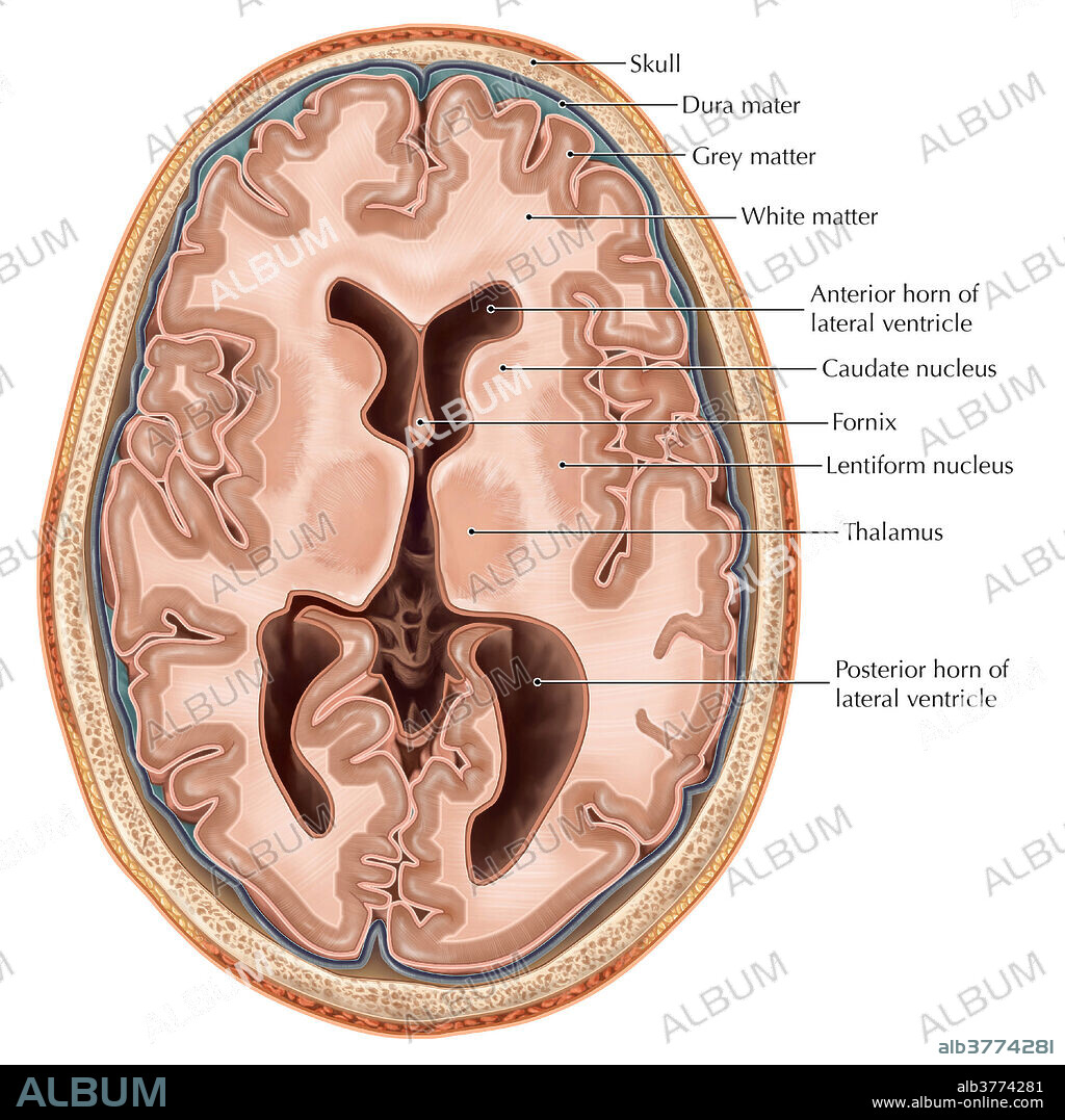 An illustrated transverse view of the brain. Depicted are the lateral ventricles, hollow cavities which are filled with cerebrospinal fluid that help nourish and support the brain and spinal cord. The telencephalon is divided into cerebral hemispheres within the brain including the cerebral cortex, white matter and the basal ganglia.