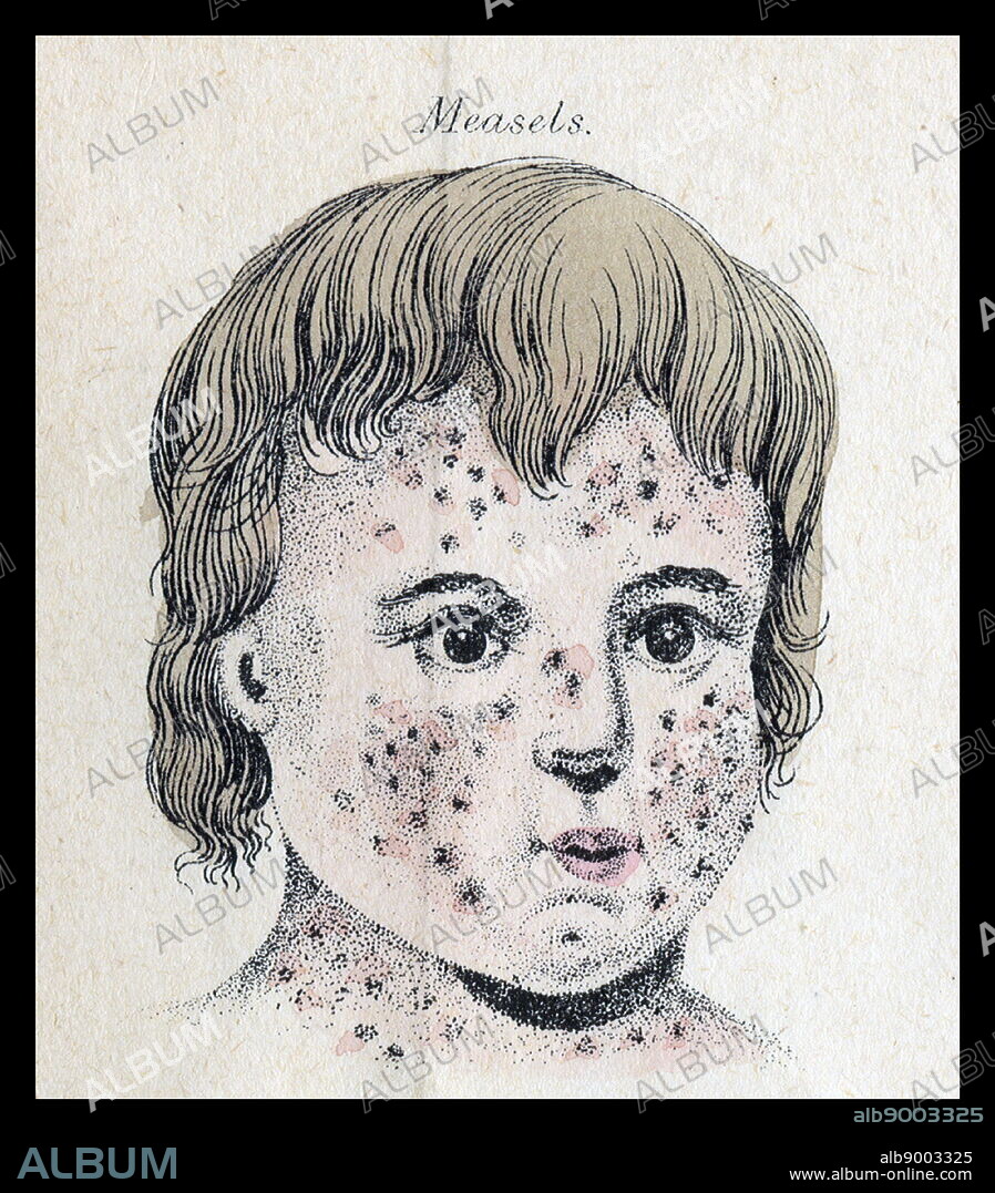 child with measles from the frontispiece of 'Domestic Medicine' by William Buchan. 1782.
