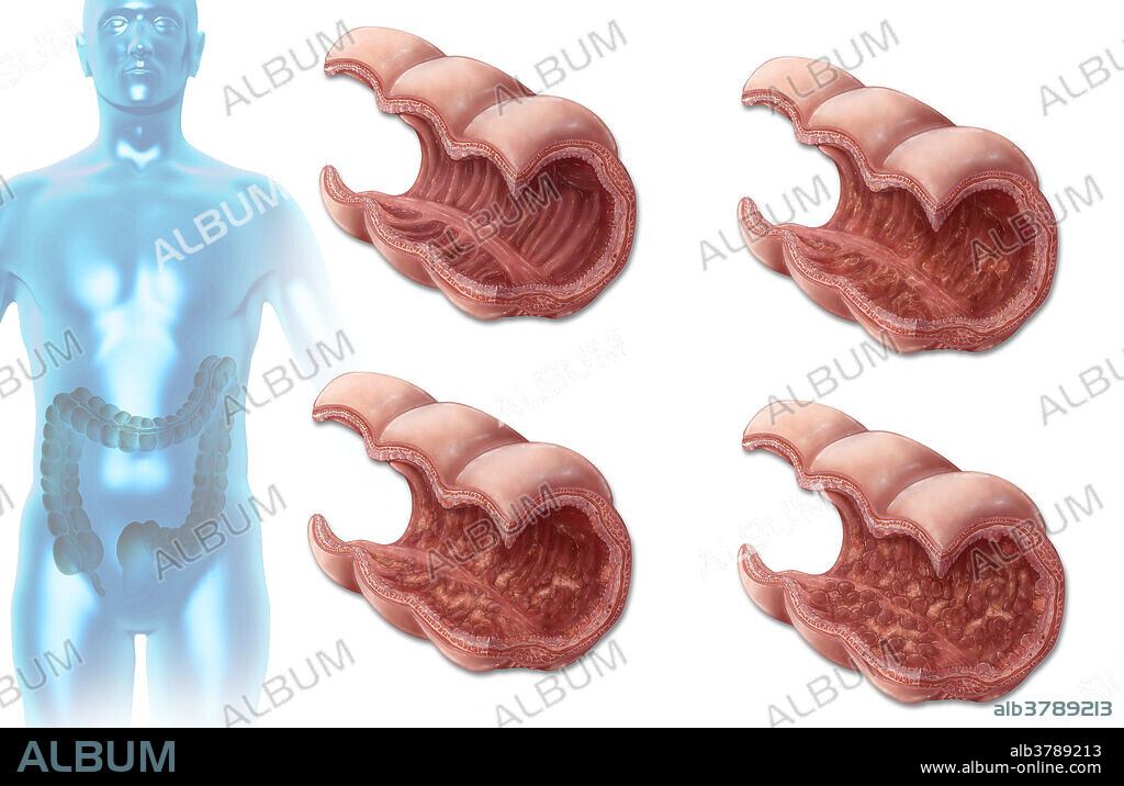 An illustration of different stages of ulcerative colitis, an inflammatory bowel disease affecting the inner lining of the large intestine. The disease is characterized by the development of ulcers which begin damaging the mucosal lining, causing inflammation and progressive loss of blood. Severe cases may progress into the growth of pseudopolyps, and patients become more at risk of developing colorectal cancer.