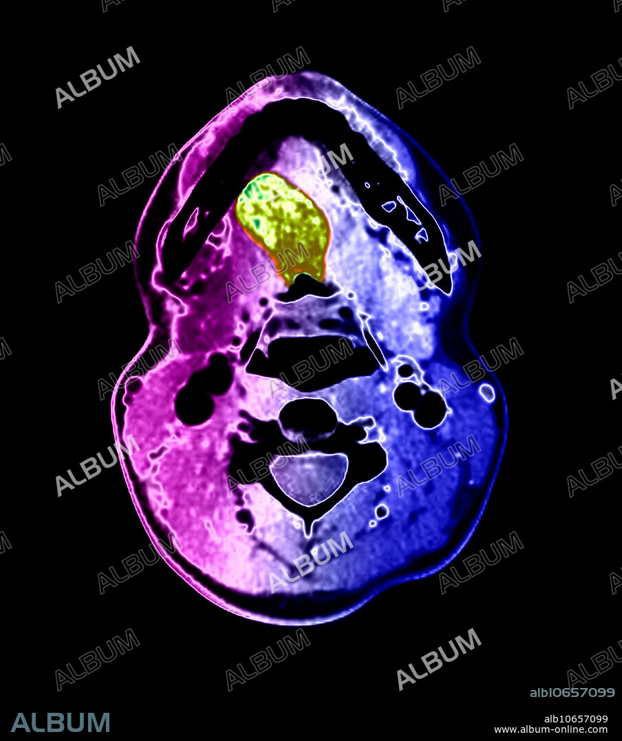 This colour-enhanced, axial (cross-sectional) CT image through the oral cavity demonstrates a large, abnormal density (green) in the tongue. This represents lingual thyroid tissue. This patient had no thyroid tissue in the expected region of the lower neck. The thyroid gland develops near the foramen cecum of the tongue and normally descends along a tract called the thyroglossal duct to the lower neck. Rarely, this normal descent does not occur and thyroid tissue remains in the tongue, but remnants of thyroid tissue and the duct itself may occur anywhere along the tract. Often, however, no thyroid tissue is present in the lower neck, only in the tongue base, as in this case.