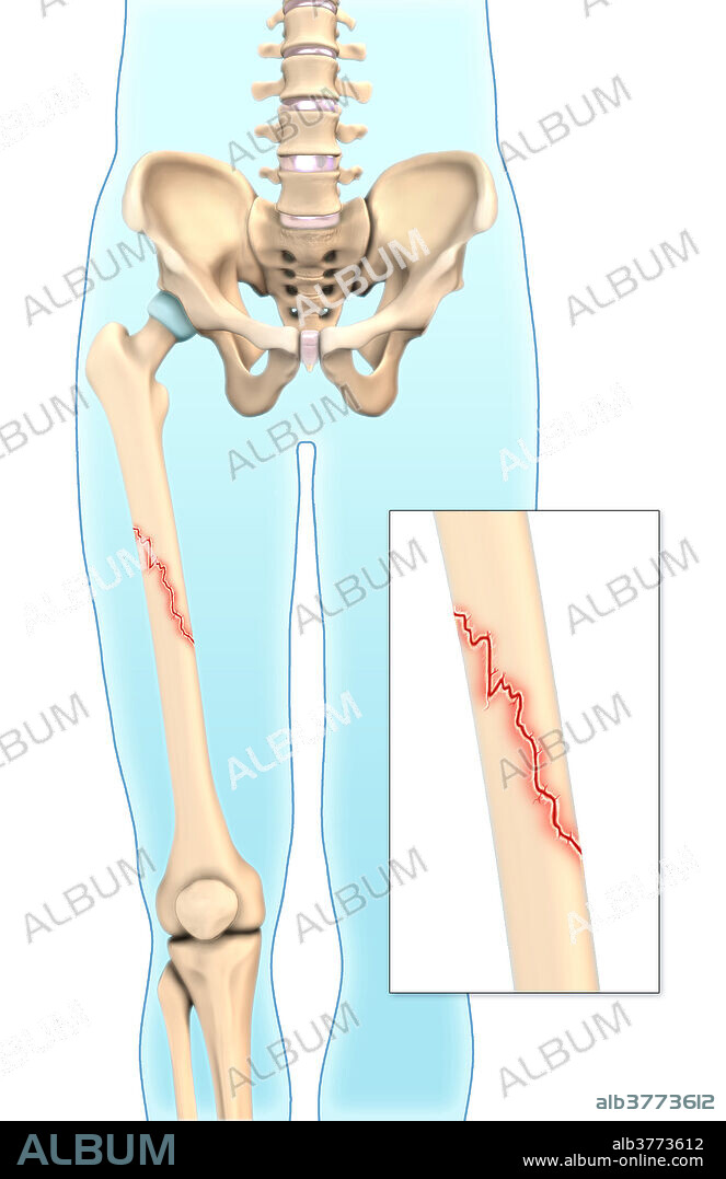 An illustration of an oblique fracture in which a break is diagonal to the bone's long axis.