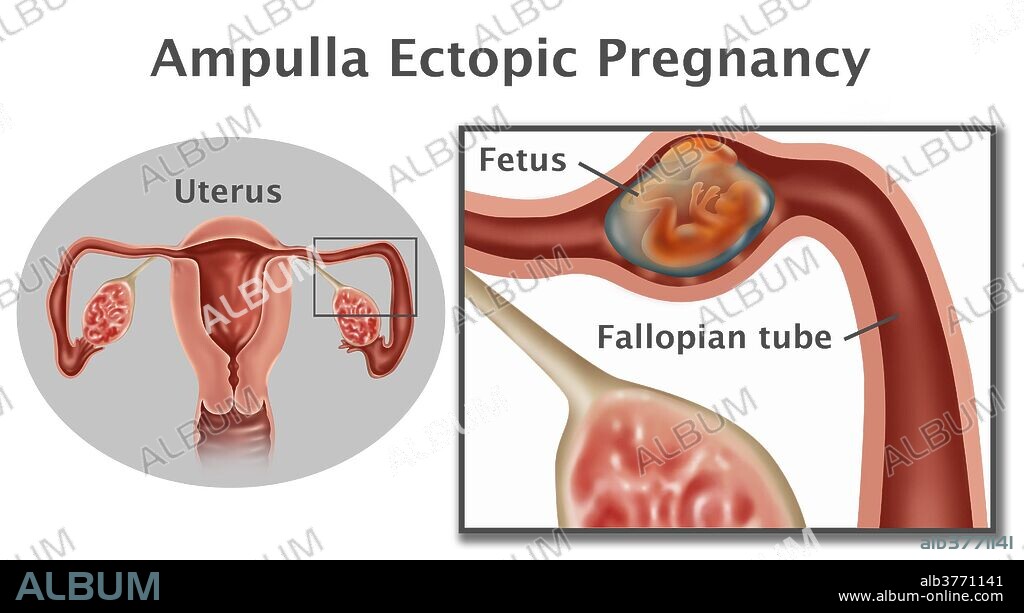 Illustration of an ampulla ectopic pregnancy; a fetus growing in the ampulla (the second portion of the fallopian tube). An ampullar pregnancy is the most common type of tubal ectopic pregnancy. It accounts for about 70% of tube pregnancies.