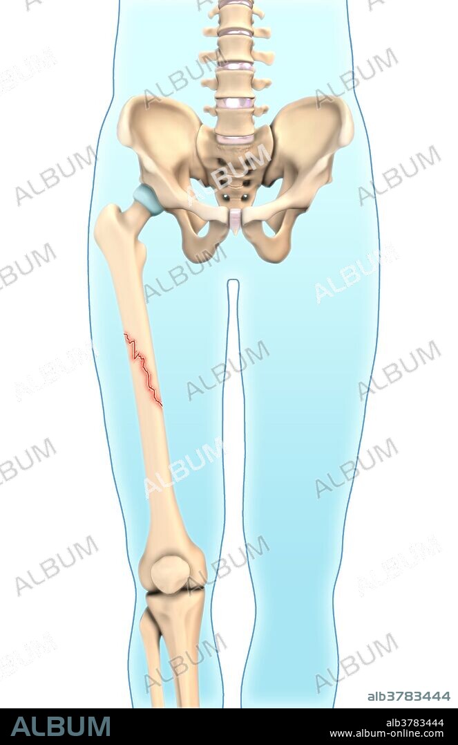 An illustration of an oblique fracture in which a break is diagonal to the bone's long axis.