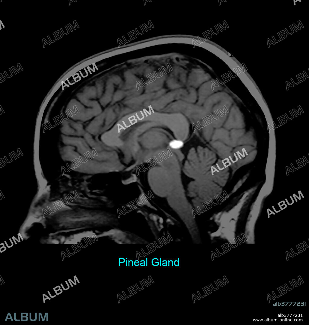 This T1 weighted sagittal (from the side) image of the brain highlights the pineal gland, which is part of the epithalamus.