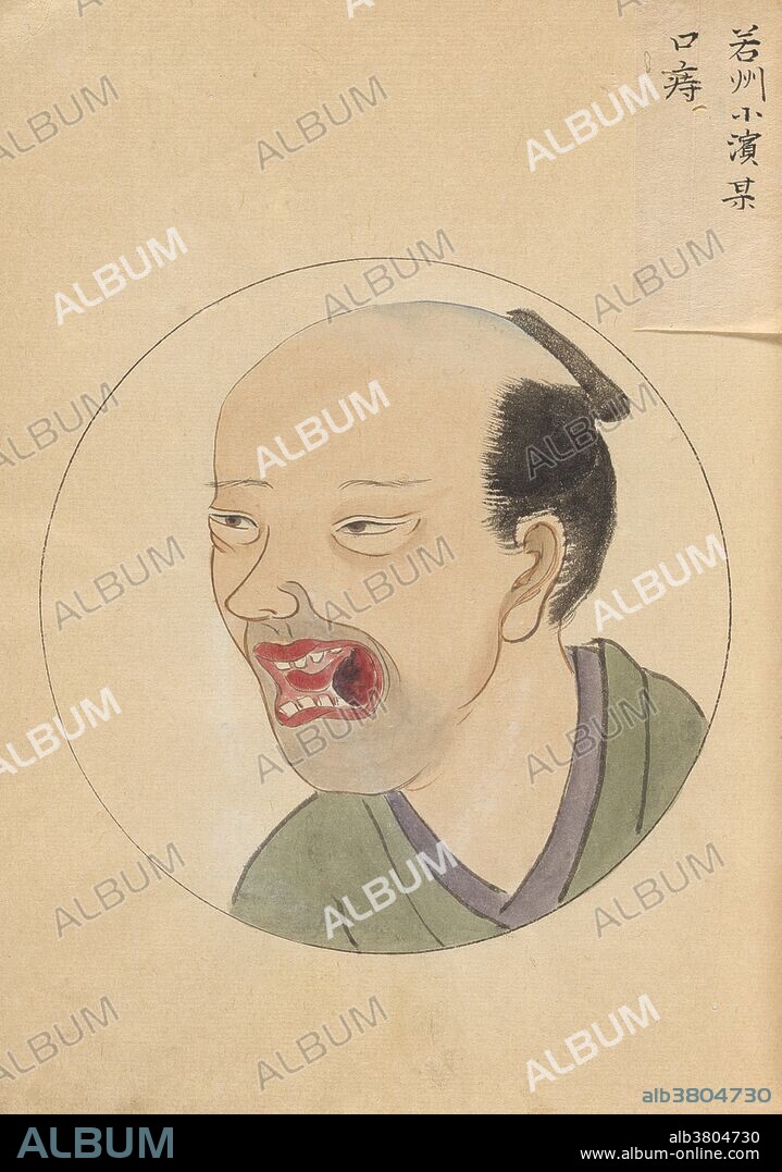 Man has an oral cancer. "A Surgical Casebook" is a manuscript of hand-painted pictures commissioned by Hanaoka Seishu. The colorful, often charming, pictures in this casebook capture the likenesses of the men and women who came to Hanaoka for treatment, and they depict graphically the medical and surgical problem to be treated. Hanaoka Seishu (October 23, 1760 - November 21, 1835) was a Japanese surgeon with a knowledge of Chinese herbal medicine, as well as Western surgical techniques. He successfully operated for hydrocele, anal fistula, and even performed certain kinds of plastic surgery. He was the first surgeon in the world who used the general anesthesia in surgery and who dared to operate on cancers of the breast and oropharynx, to remove necrotic bone, and to perform amputations of the extremities in Japan. He also devised and modified surgical instruments, and trained and educated many students, using his own philosophy for medical management. He died in 1835 at the age of 75.