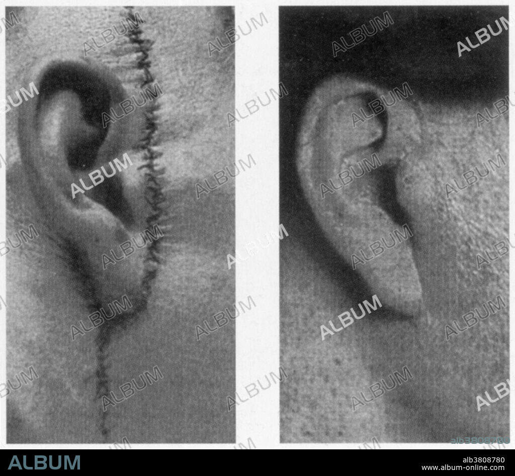These two images show improvements in plastic surgery, c. 1920s.  On the left is a prominent scar from a cheek lift.  On the right is a cheek lift in which the surgeon made an incision behind the ear, leaving no scar.  The person who revised this technique was German plastic surgeon Jacques Joseph (1865-1934).