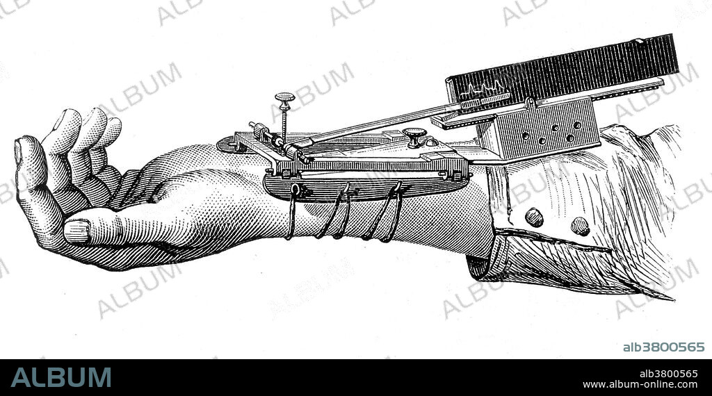 Engraving of Marey's sphygmograph, 1885. The sphygmograph was a mechanical device used to measure blood pressure in the mid-19th century. It was developed in 1854 by German physiologist Karl von Vierordt (1818-1884). It is considered the first external, non-intrusive device used to estimate blood pressure. The device was a system of levers hooked to a scale-pan in which weights were placed to determine the amount of external pressure needed to stop blood flow in the radial artery. Although the instrument was cumbersome and its measurements imprecise, the basic concept of Vierordt's sphygmograph eventually led to the blood pressure cuff used today. In 1863, Etienne-Jules Marey (1830-1904), improved the device by making it portable. Also he included a specialized instrument to be placed above the radial artery that was able to magnify pulse waves and record them on paper with an attached pen. Marey (1830-1904) was a French scientist, physiologist and pioneer of early photography.