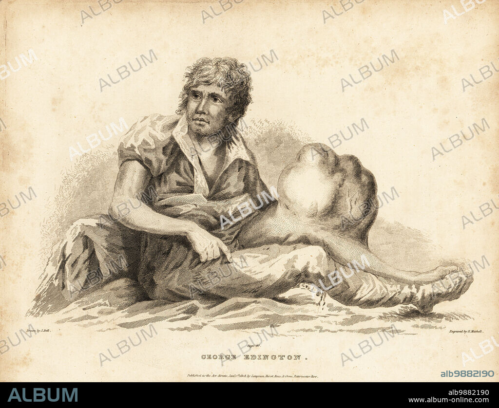 George Edington with his giant tumor on his leg, aged 40, 1806. Broke his leg in a riding accident in 1798, and the resulting ulcerous bone tumor continued to grow. Also named Edward Edington in the text. Copperplate engraving by Edward Mitchell after an illustration by John Bell from his own Principles of Surgery, as they Relate to Wounds, Ulcers and Fistulas, Longman, Hurst, Rees, Orme and Brown, London, 1815.