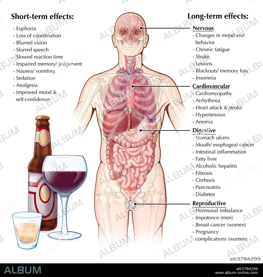 An illustrated diagram depicting the major organ systems affected by alcohol consumption. Alcohol abuse can result in long term affects on the brain such as damaged neurons, impaired memory and personality disorders, along with short term affects such as loss of motor coordination and cognitive function. Long term drinking also affects heart health, resulting in conditions such as alcoholic cardiomyopathy, arrhythmia, coronary heart disease, strokes and high blood pressure. The liver eventually becomes damaged from filtering alcohol out of the blood, resulting in conditions such as cirrhosis which can eventually lead to liver failure. Alcohol abuse also increases the risk of stomach ulcers, inflammation and cancer within the digestive tract. Alcohol also has a diuretic effect, which increases urine volume and fluid loss. Both men and women's reproductive health may be affected by long term alcohol abuse with altered hormone levels, impotence in men and increased risk of birth defects in pregnant women.