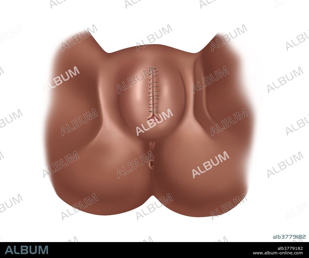 Illustration of total infibulation; labia majora are connected over the urethra and vaginal opening with only a small posterior opening left for urination and menstruation. Female infibulation, is considered Type III female genital mutilation by the World Health Organization. It is mostly practiced in northeastern Africa, particularly Djibouti, Eritrea, Ethiopia, Somalia and Sudan. Although female genital mutilation has been outlawed or restricted in most of the countries in which it occurs, but the laws are poorly enforced.
